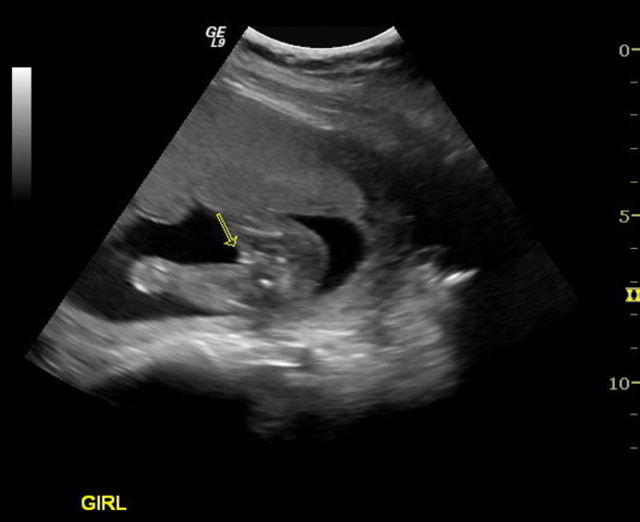 Week 20 Ultrasound