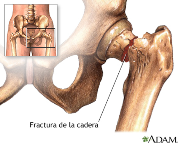 Me fracture la cadera