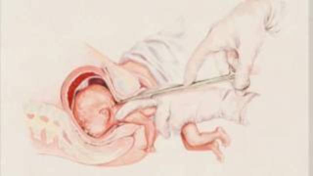 Partial-birth Abortion Banned