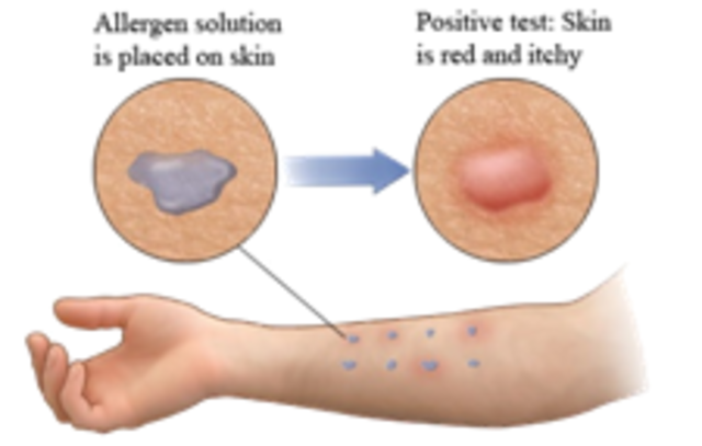 Radioallergosorbent Test Invented