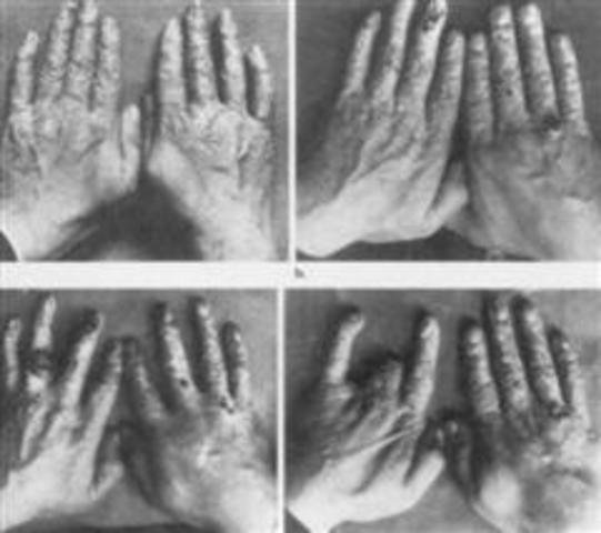 X hizpien arriskuen inguruko lehenengo dokumentua.