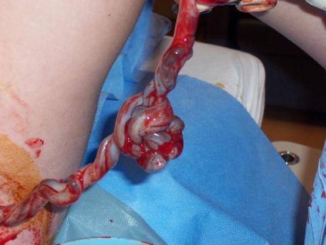 Dr. Oz Recommends Saving a Newborn's Cord Blood Stem Cells