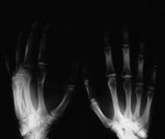 Roentgen discovered X-Rays