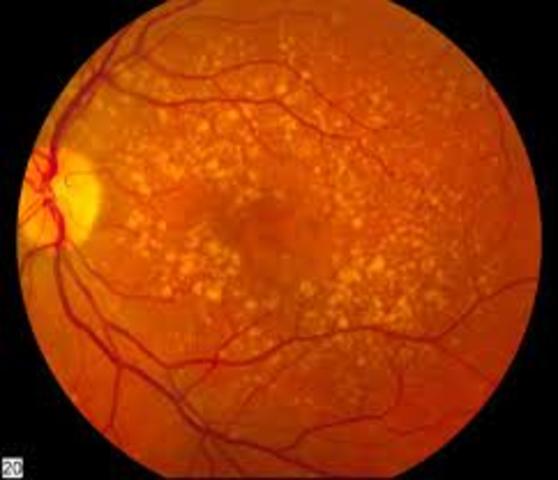 Develop Macular Degenration
