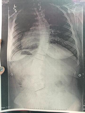 Scoliosis