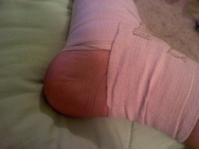 I fractured my foot