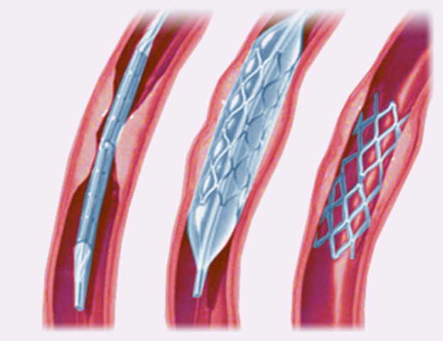 Percutaneous transluminal coronary angioplasty (PTCA)