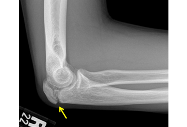 Broke my Right Elbow