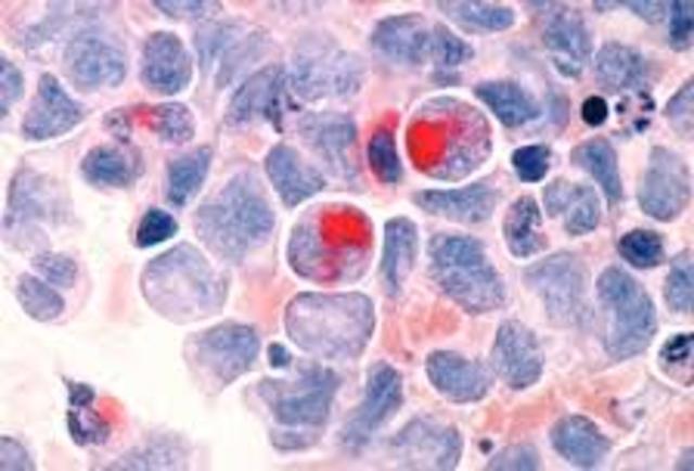 Rudolf Virchow proposed that disease is caused by the malfunction of cells.