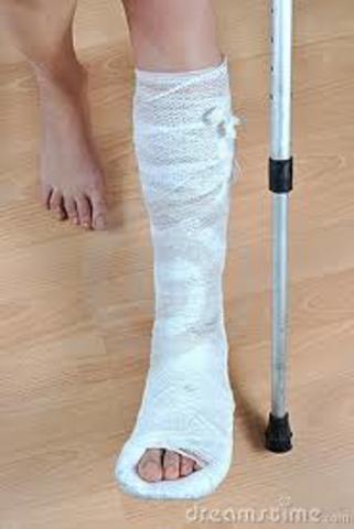 Broken Leg