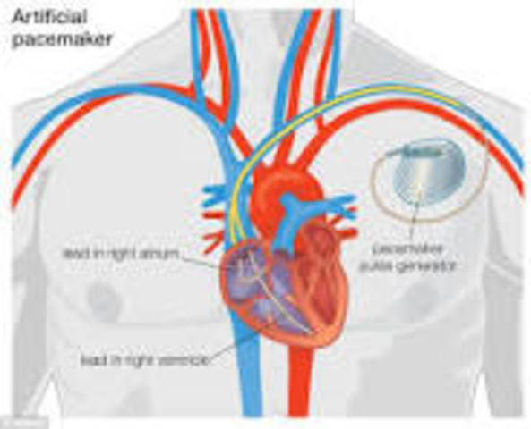 Heart Pacemaker