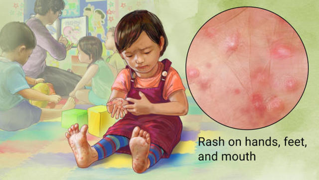 hands foot-and-mouth disease first reported in the United States