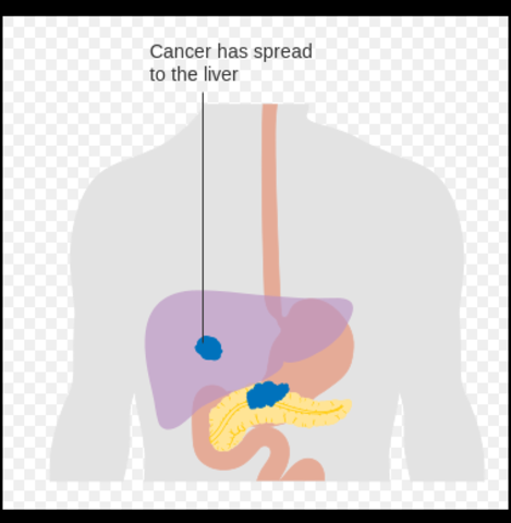 Pancreatic tumor removed