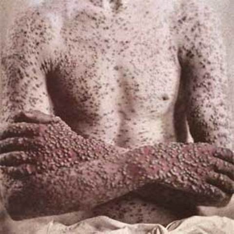 Smallpox Epidemic  in New England