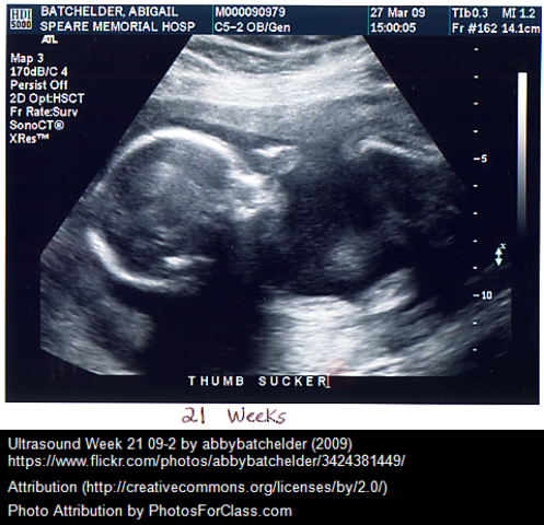 Ian Donald and the Ultrasound