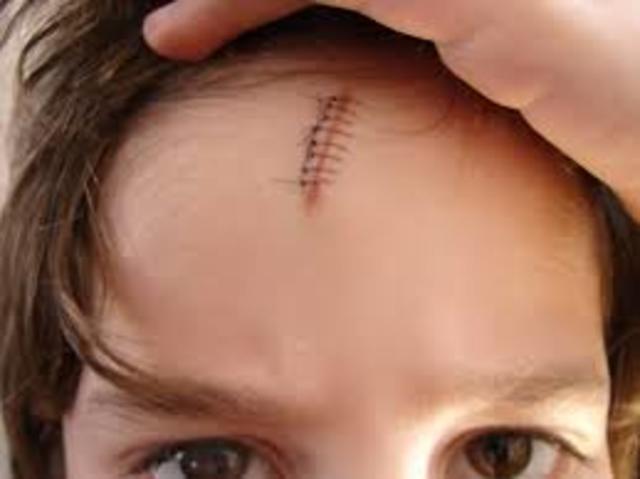 First stitches