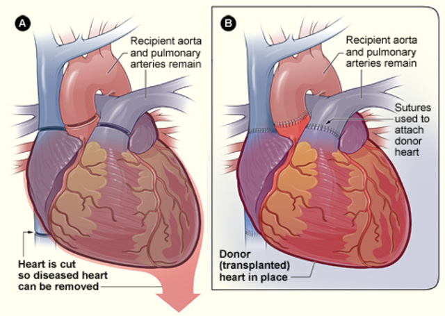 Human heart transplant