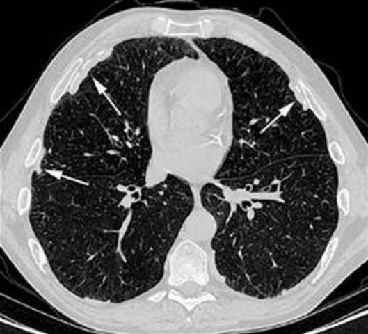 Camp Morton near Indianapolis