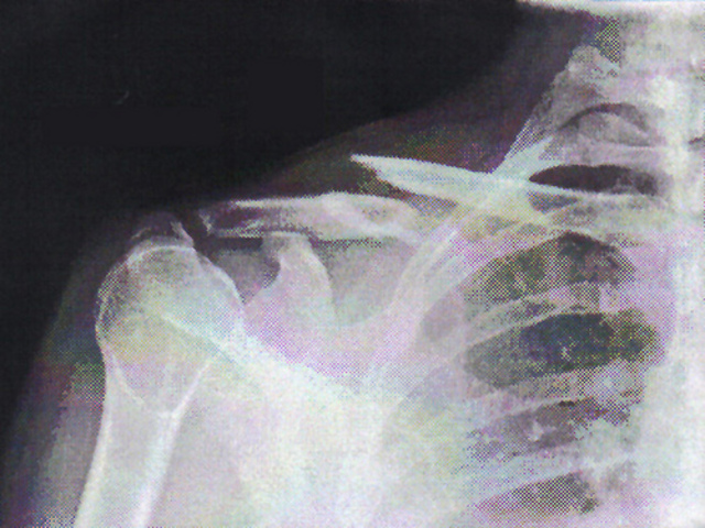 Broken Collarbone!
