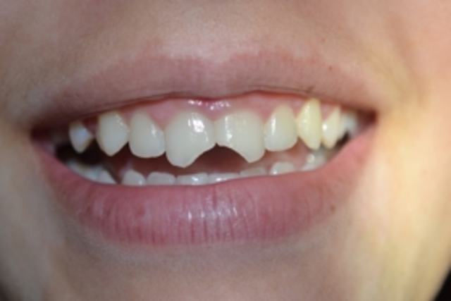 Chipped Teeth