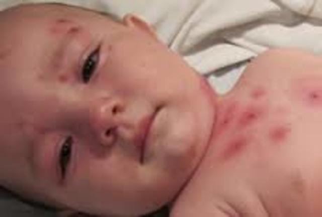 ultimo caso de viruela en el mundo