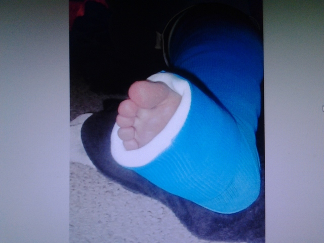 mi hermana rompo su pierna