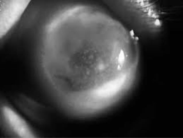 Querotoplastía (transplante de cornea), Edward K. Zirn