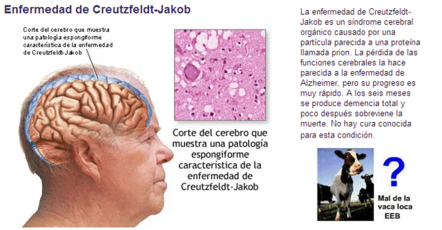 Encefalopatía Espongiforme bovina “vacas locas” Creutzfeldt-Jakob.
