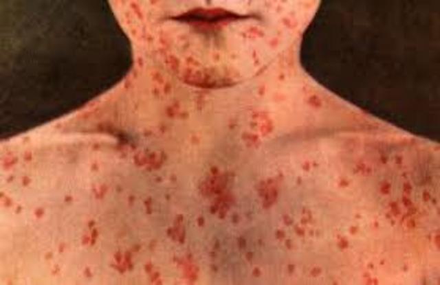 Primera gran epidemia de viruela