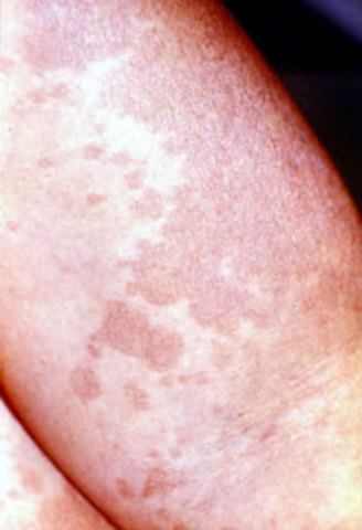 ENFERMEDAD CUTANEA HUMANA (PITIRIASIS VERSICOLOR)