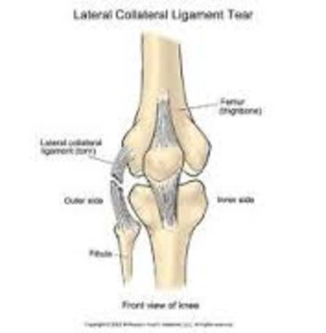 Broken Femur / Torn MCL