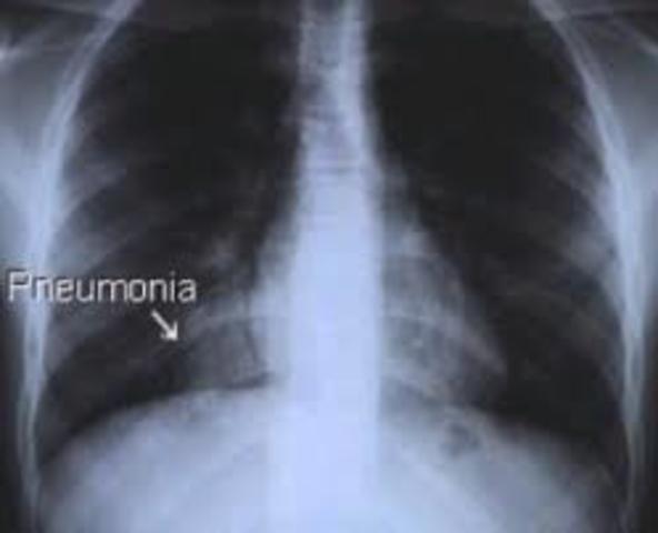 La neumonía atípica