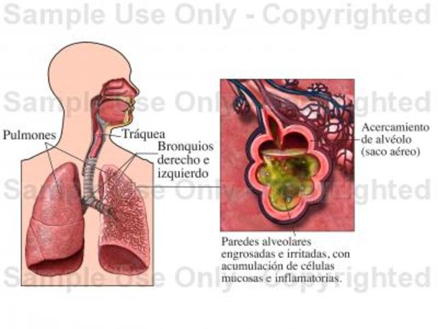 SÍNDROME RESPIRATORIO AGUDO Y GRAVE (SARS)