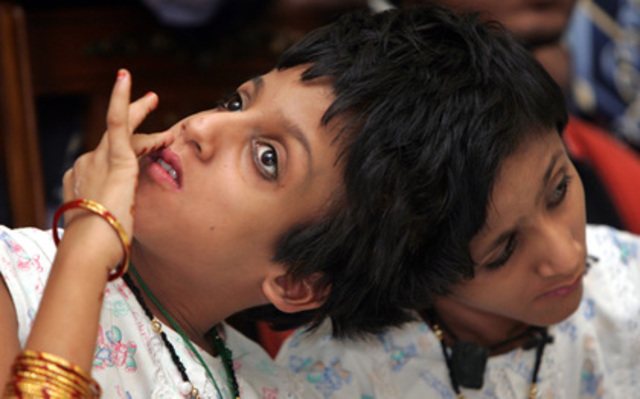 The first successful separation of conjoined twins at the head