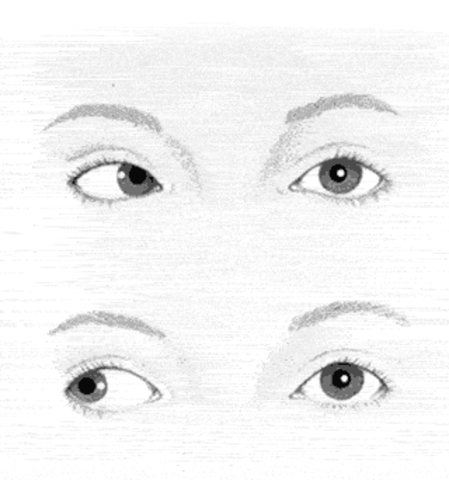 Me diagnosticarón estrabismo