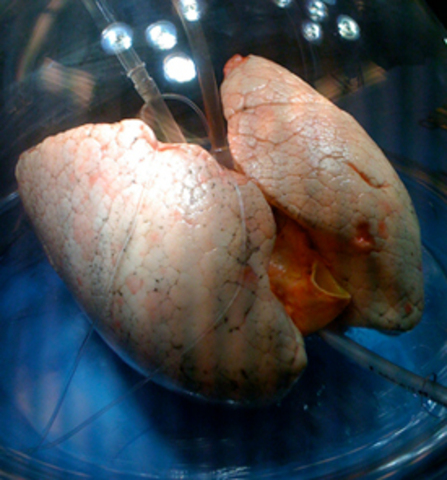 Dr. Shaf Keshavjee and the TGH lung transplant team used a new technique called XVIVO Lung Perfusion System