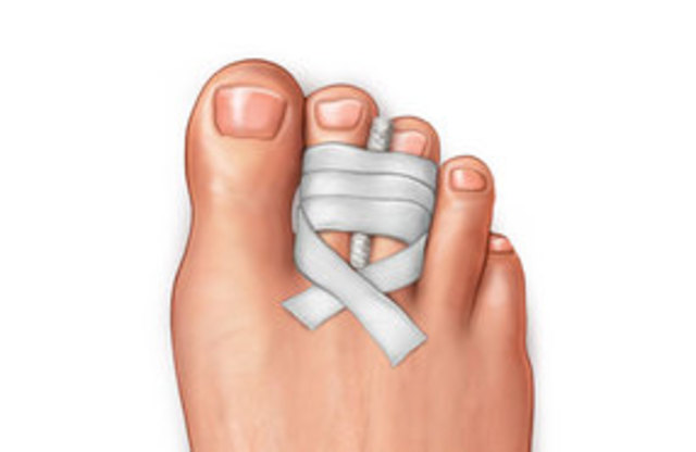 My toe gets broken