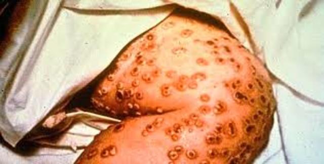 Last Smallpox Case in United States
