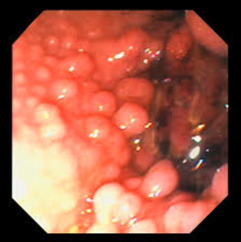 De'Andre Has Surgery