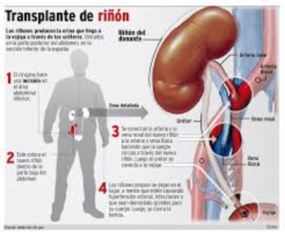 Primer Transplante de Riñon