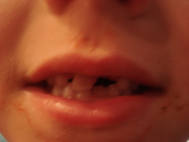 Lost 1st tooth