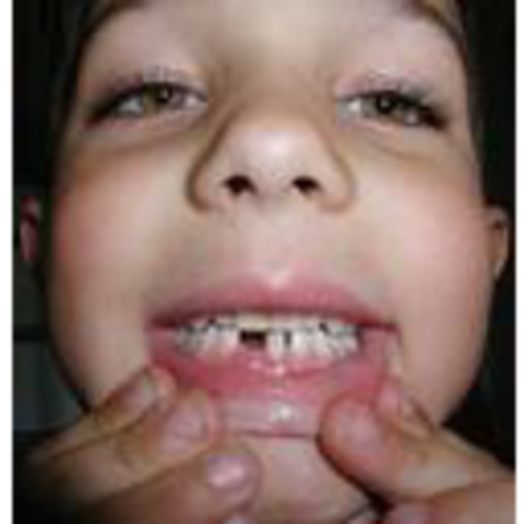 Lost my first baby tooth..