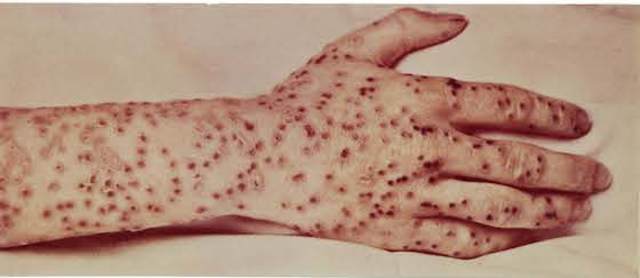 Smallpox Epidemic