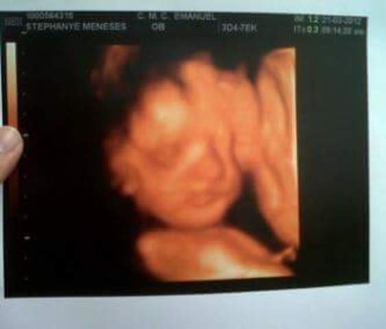 La primera ecografia 3D