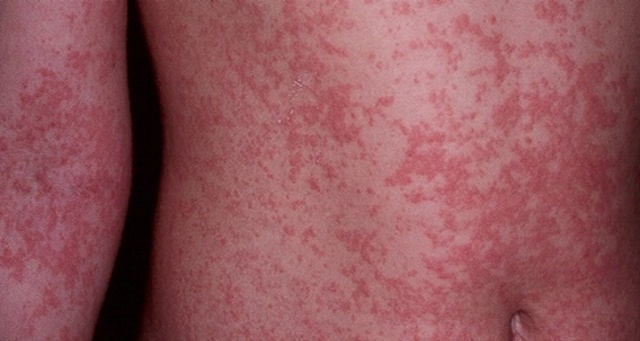 Casos suspeitos e confirmados