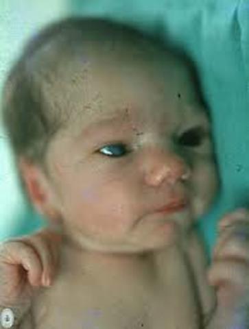 VACUNA CONTRA LA RUBEOLA