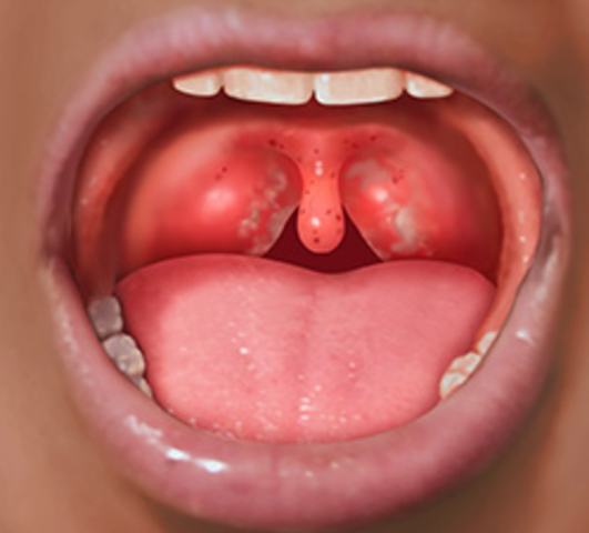 Discovery of Strep Throat Disease