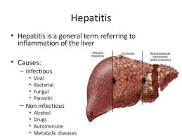 Hepatitis Outbreak in Millitary