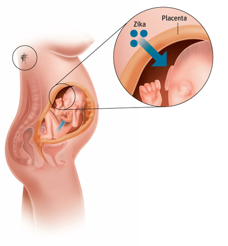 ZIKA E A MICROCEFALIA.