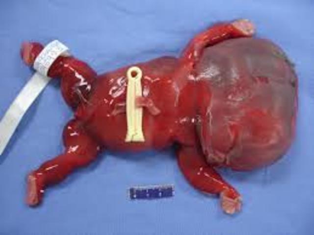 ZIKA PODE ESTAR ASSOCIADA A OUTRA CONDIÇÃO FETAL GRAVE.